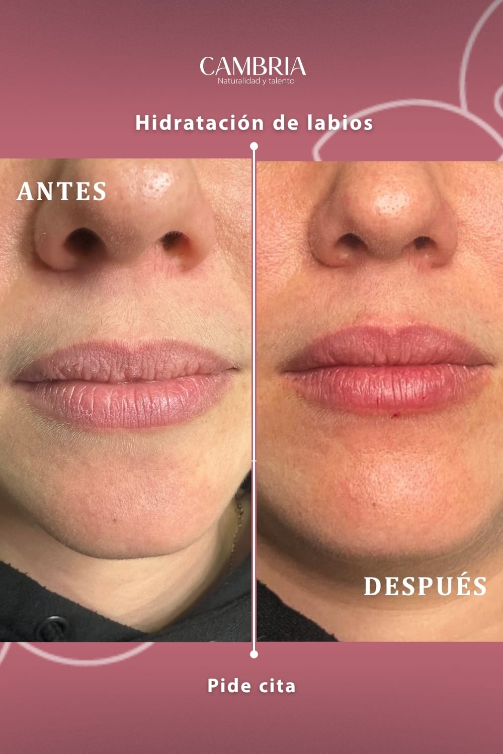 Tratamiento con Acido Hialuronico en Labios
