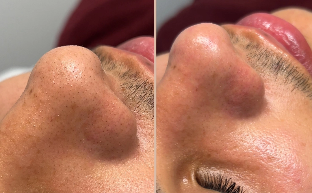 Tratamiento de Higiene Facial Profunda