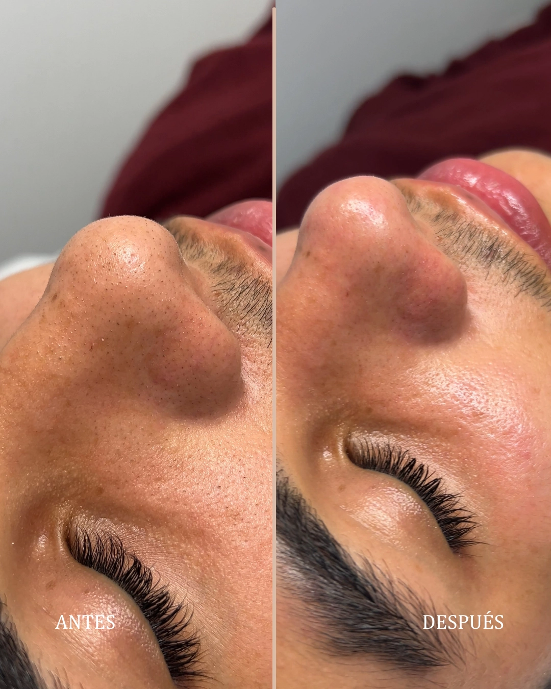 Tratamiento de Higiene Facial Profunda